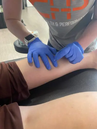 Dry needling in physical therapy setting
