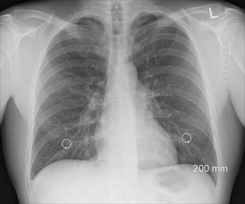 chest xray